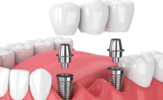 implant supported bridge